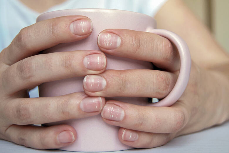 Wiele białych plam na paznokciach (Leukonychia) z powodu niedoboru wapnia lub stresu. Kobiece dłonie trzymające kubek