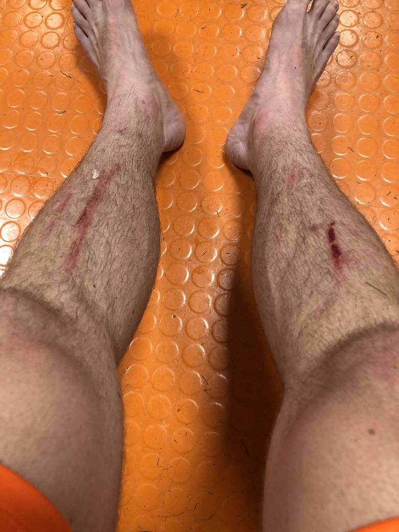 Tak wyglądały nogi Filipa Jagiełly po meczu z Lechem Poznań