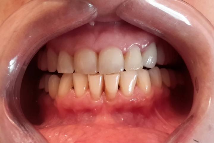 Paradontoza rozwija się wskutek narastania płytki nazębnej, z którą walczyć pomaga dentysta. Regularne usuwanie osadów z zębów pomaga chronić je też