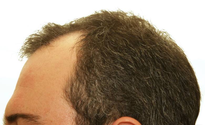 Przeszczep włosów jest ratunkiem dla osób dotkniętych problemem łysienia. Najczęstszym jego typem jest tzw. łysienie androgenowe, które występuje zarówno