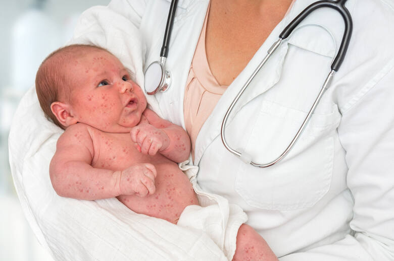Lekarz trzymający noworodka chorego na różyczkę lub odrę