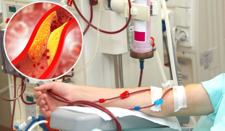 Dializa krwi i cholesterol odkładający się wewnątrz żył