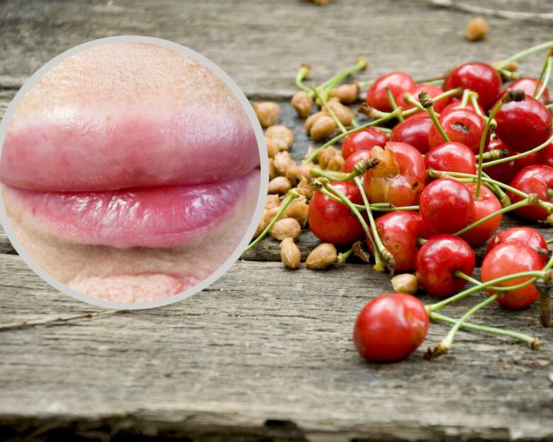 Czereśnie, pestki i ogonki na stole i usta spuchnięte od alergii