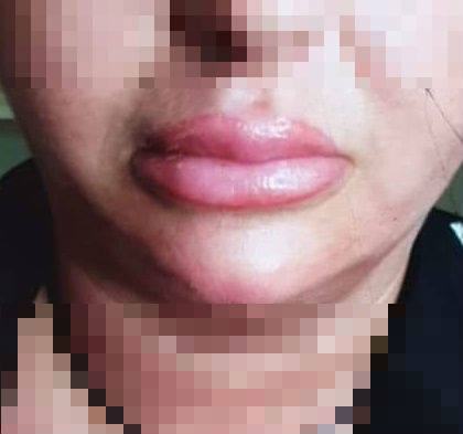 Takie zdjęcie ust pani Laury, wykonane tuż po zabiegu, przesłała nam kosmetolog