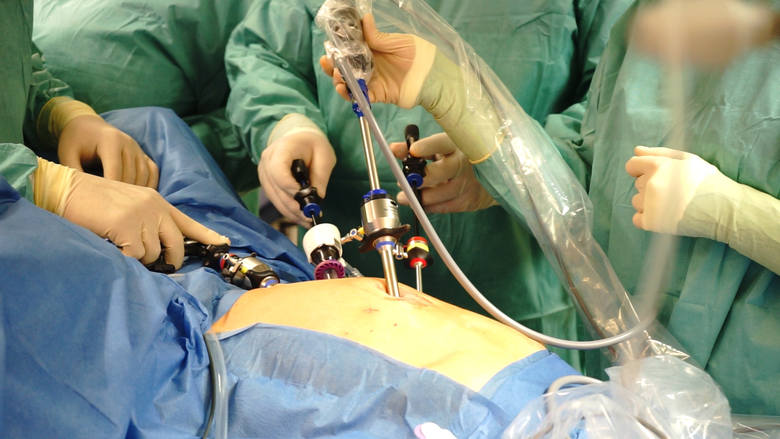 Szpital Kopernika leczy raka laparoskopowo. Nowe zabiegi laparoskopowe w regionie łódzkim