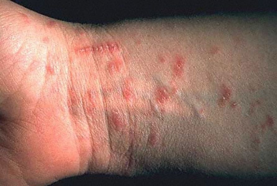 Slideshow: Pictures of scabies - WebMD Boots