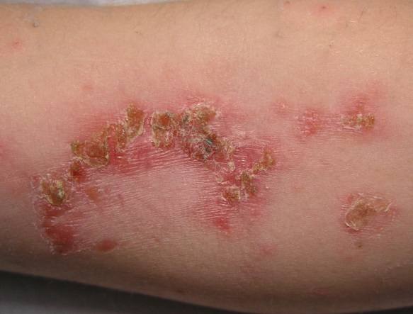 Liszajec pospolity, inaczej zakaźny, to bakteryjna infekcja powierzchniowych warstw skóry, która grozi powikłaniami zdrowotnymi.