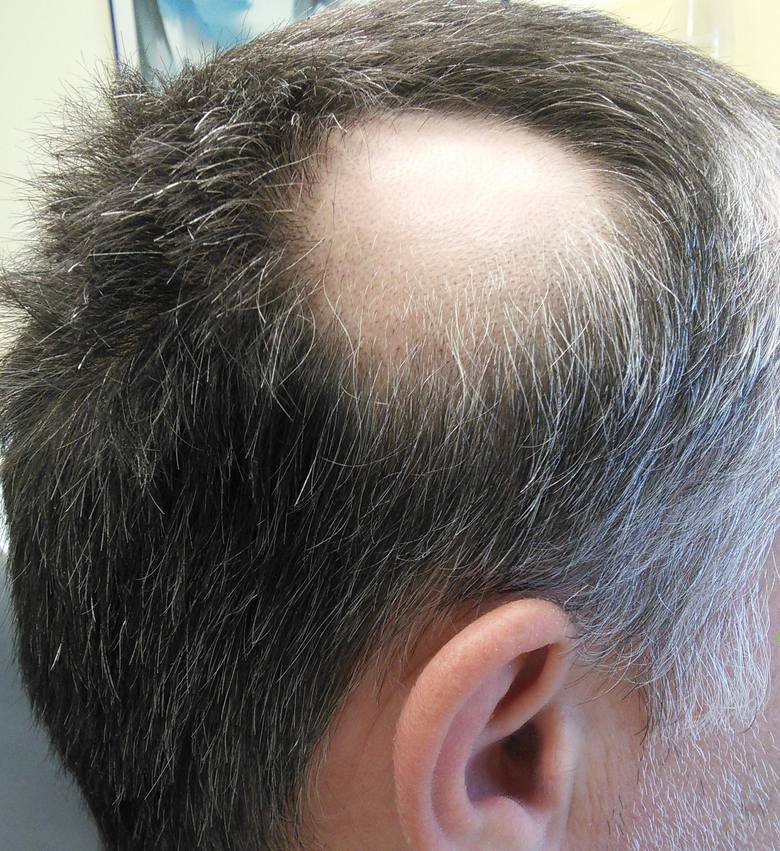Przyczyną miejscowego wypadania włosów może być łysienie plackowate. Uważa się, że jest nieuleczalną chorobą o podłoży autoimmunologicznym. Leczenie