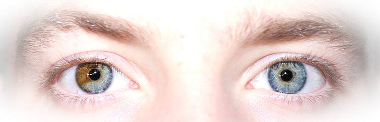 Heterochromia: przyczyny, objawy, leczenie. Heterochromia oczu: choroba czy wyjątkowa uroda?