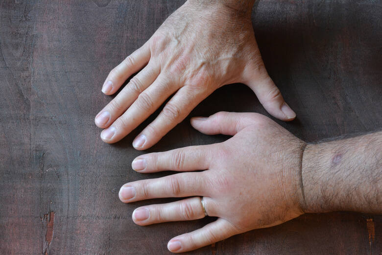 Opuchnięta dłoń męska z obrączką obok dłoni nie objętej obrzękiem