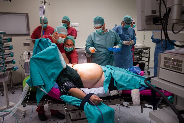Operacja bariatryczna (zmniejszania żołądka) w Zespolonym Szpitalu Wojewódzkim w Białymstoku