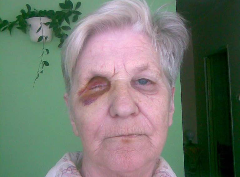 Osiem lat temu pani Józefa straciła oko po nieudanym zabiegu usunięcia zaćmy
