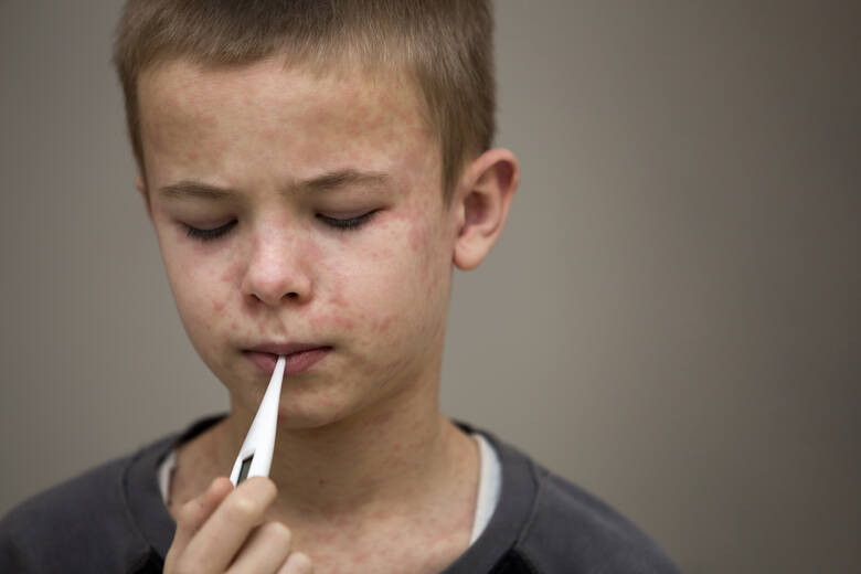 Chłopiec chory na odrę z termometrem w ustach
