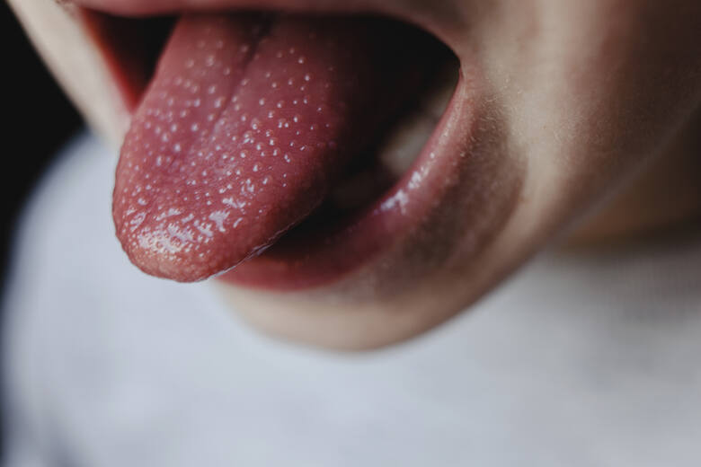 Widok truskawkowego języka u dziecka chorego na szkarlatynę