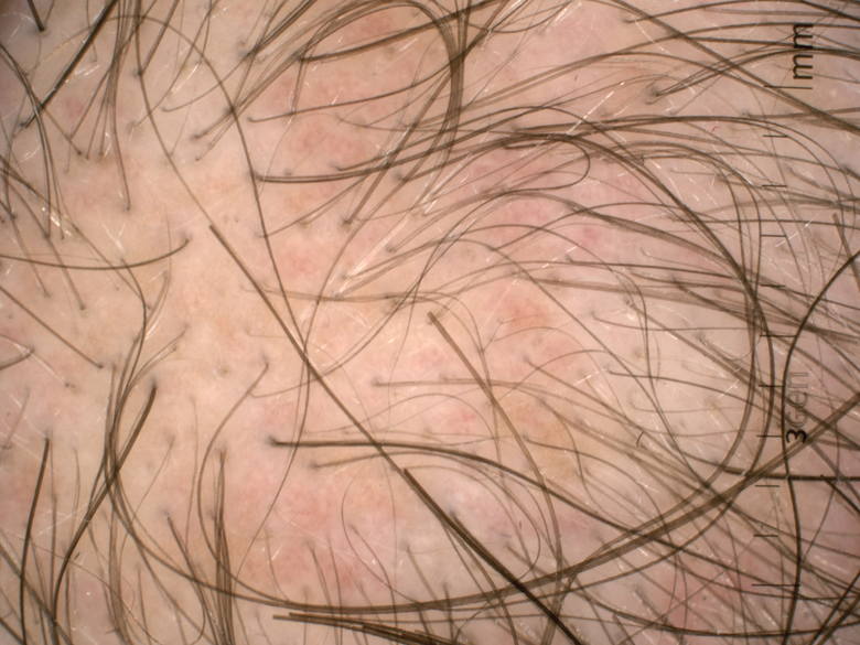 Obraz skóry owłosionej głowy, widoczne są włosy zminiaturyzowane w przebiegu łysienia androgenowego u mężczyzny