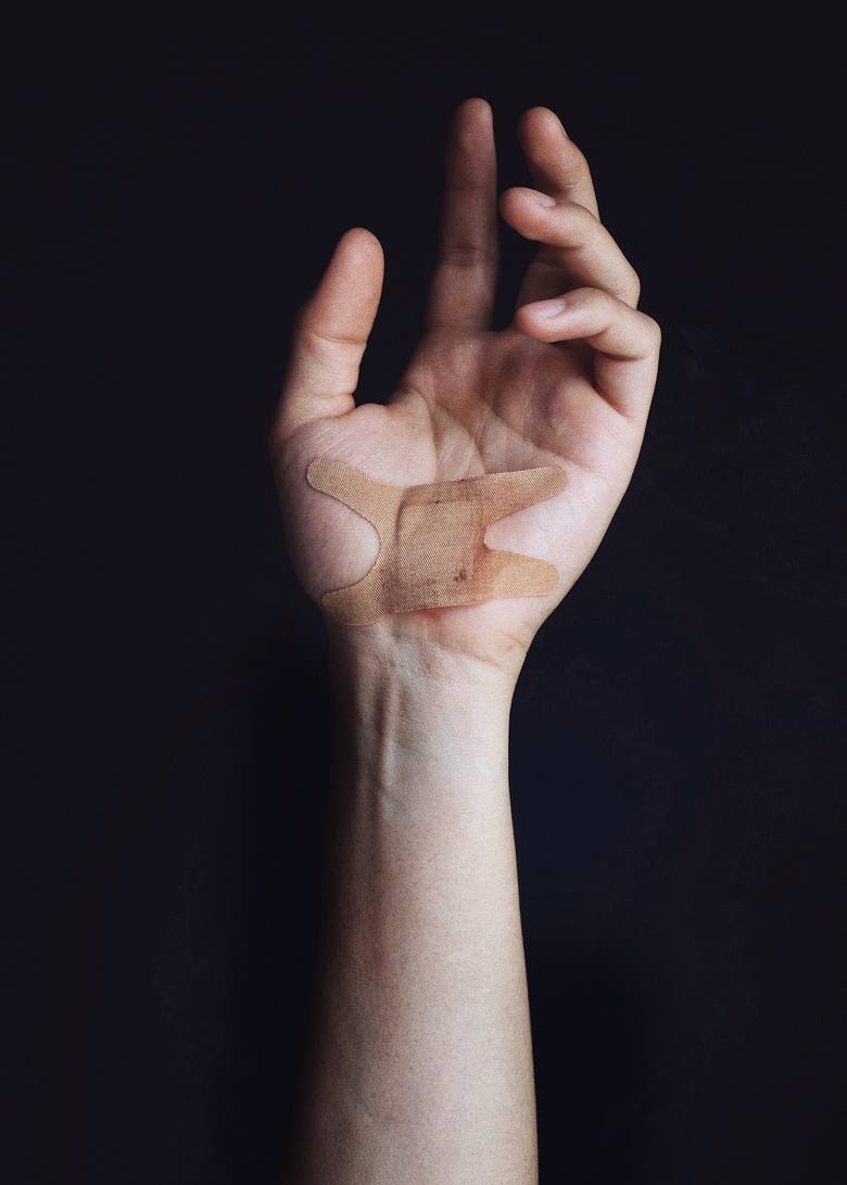 Blizny na dłoniach mogą zmniejszać się szybciej niż te zlokalizowane w innych częściach ciała, ponieważ ich skóra ulega szybszej regeneracji. Tak jak