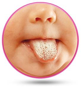 Pleśniawka u dzieci występują na języku i w całej jamie ustnej