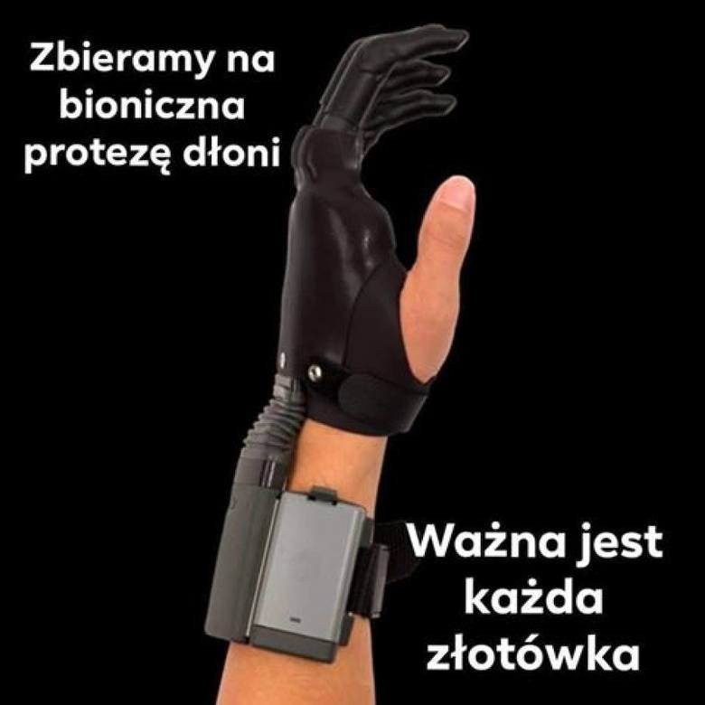 Proteza dłoni kosztuje 197 tys. zł. 