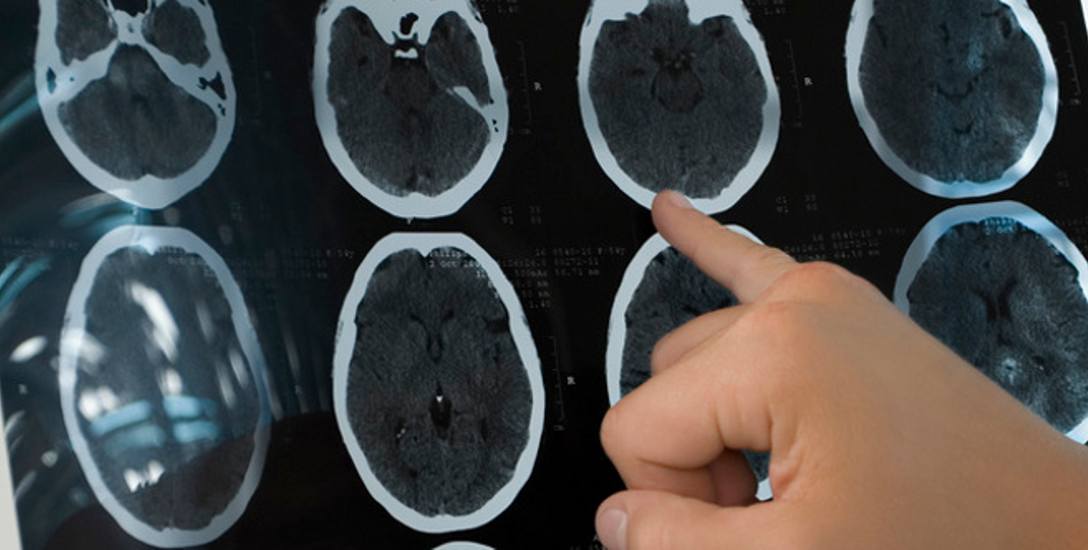 Mózg po udarze poddany tlenoterapii