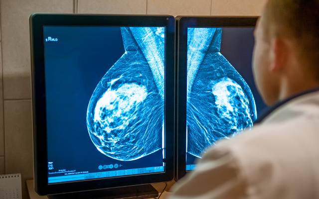 Zaawansowany rak piersi może być leczony, ale dostęp do terapii jest nierówny. Jakie problemy mają polskie pacjentki? Zobacz wyniki raportu