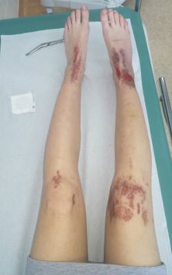 Nogi pacjentki w trakcie leczenia oparzeń