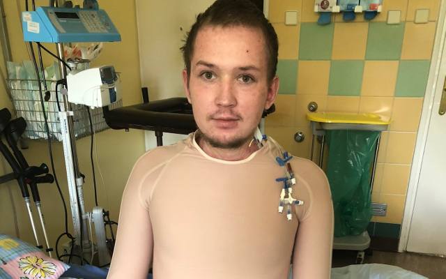 Kraków. Lekarze uratowali skrajnie poparzonego pacjenta