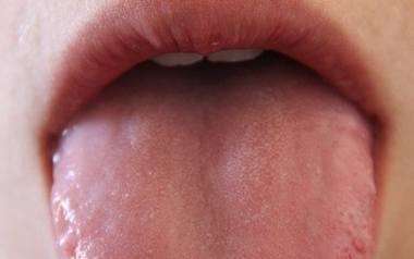Biały nalot na języku – przyczyny, objawy, leczenie
