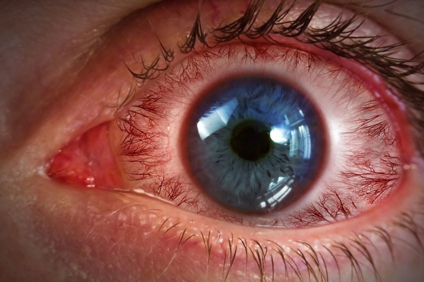 Czerwone Oczy O Czym Mogą świadczyć I Jak Pozbyć Się Tego Problemu Poznaj Domowe Sposoby Na 8846