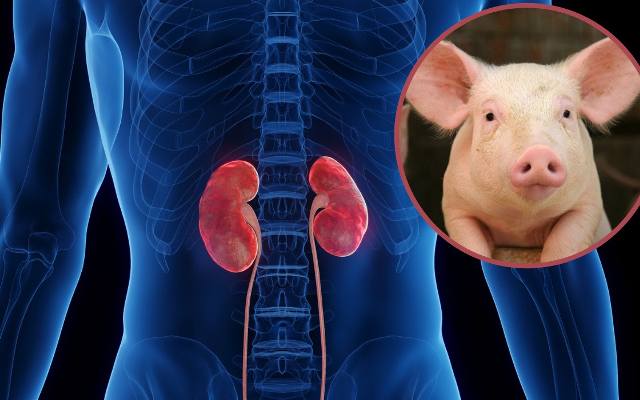 Mężczyzna z nerką od zmodyfikowanej genetycznie świni opuścił szpital. To pierwszy taki przeszczep na świecie