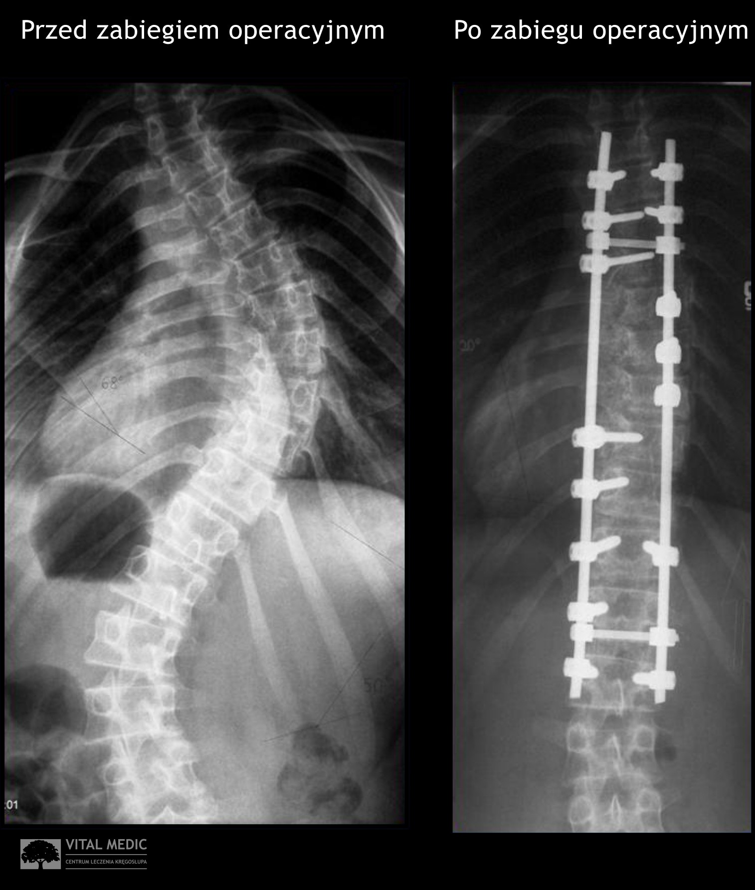 Skolioza Dziecięca Deformacja Kręgosłupa Rodzic Pierwszy Rozpozna Chorobę Dziennikzachodnipl 6979