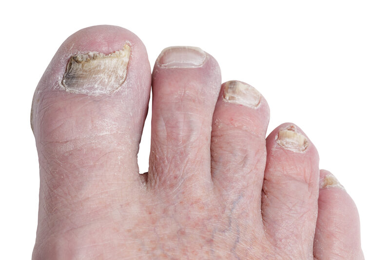 Jaka choroba widoczna jest na tym paznokciu?